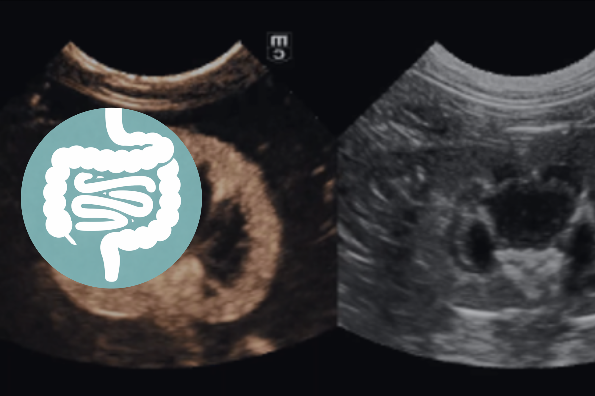 Echo abdomen advanced module 1